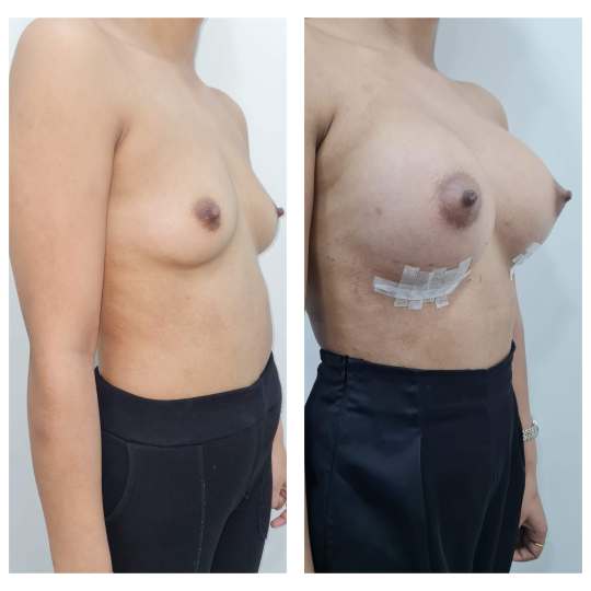 Patient Breast Implant KOQ10